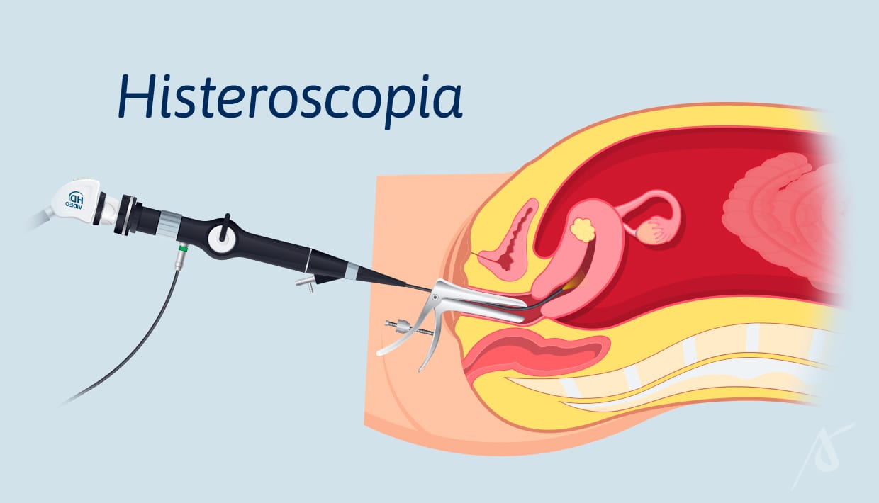 Histeroscopia ambulatorial