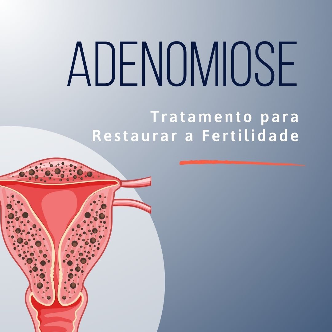 Adenomiose: Tratamento